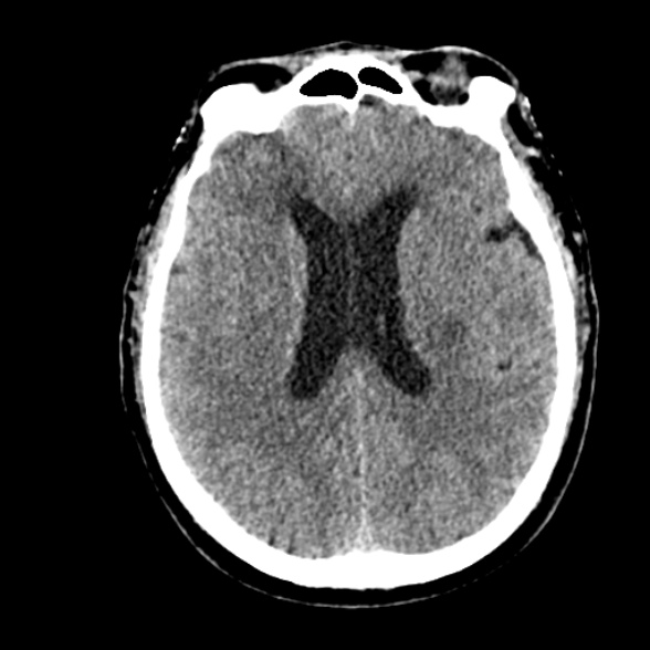 Basilar artery thrombosis (Radiopaedia 53351-59352 Axial non-contrast 72).jpg