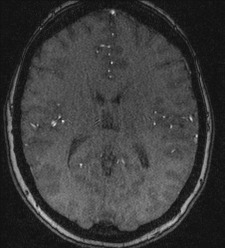 Basilar tip aneurysm (Radiopaedia 26504-26632 MRA 145).jpg