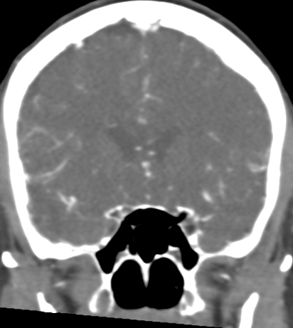 Basilar tip aneurysm with coiling (Radiopaedia 53912-60086 B 51).jpg