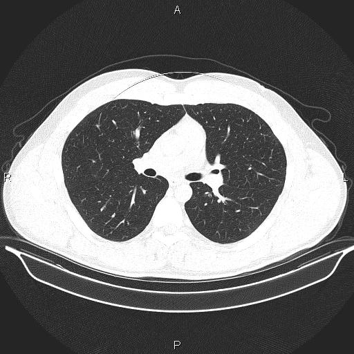 File:Beam hardening and ring artifacts (Radiopaedia 85323-100915 Axial lung window 35).jpg