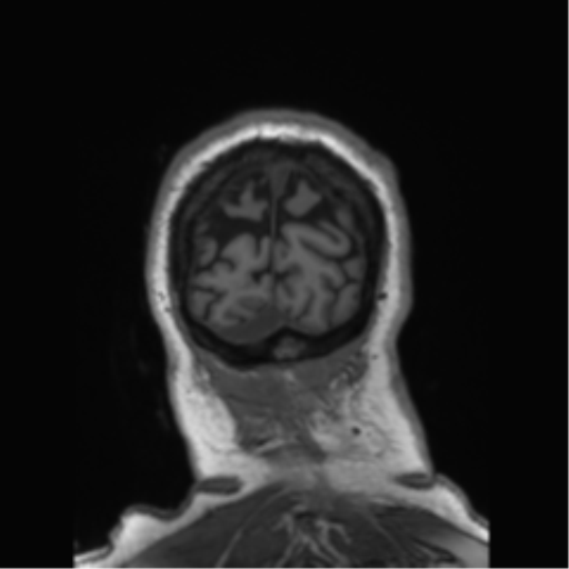 Behavioral variant frontotemporal dementia and late onset schizophrenia (Radiopaedia 52197-58083 Coronal T1 16).png
