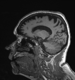Behavioral variant frontotemporal dementia and late onset schizophrenia (Radiopaedia 52197-58083 Sagittal T1 34).png