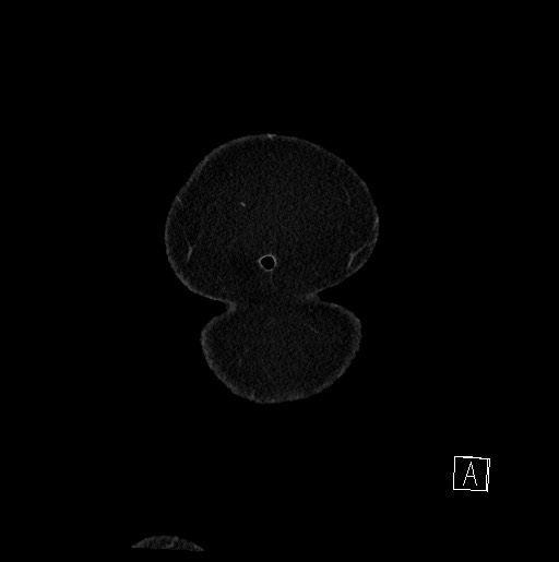 Below filter IVC thrombosis (Radiopaedia 58187-65266 B 9).jpg