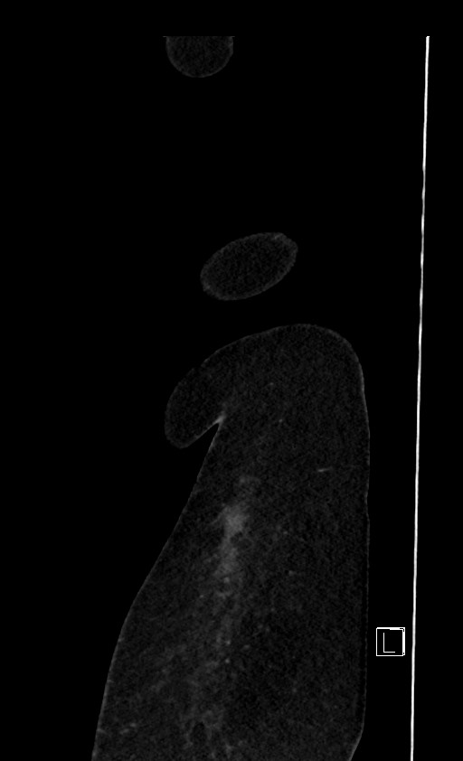 Below filter IVC thrombosis (Radiopaedia 58187-65266 C 18).jpg