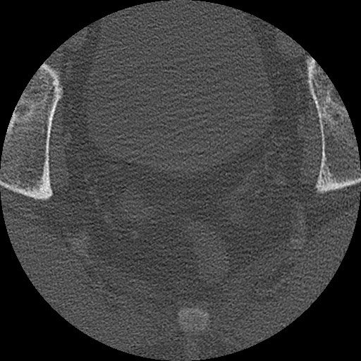 Benign post-traumatic pseudopneumoperitoneum (Radiopaedia 71199-81495 Axial bone window 321).jpg