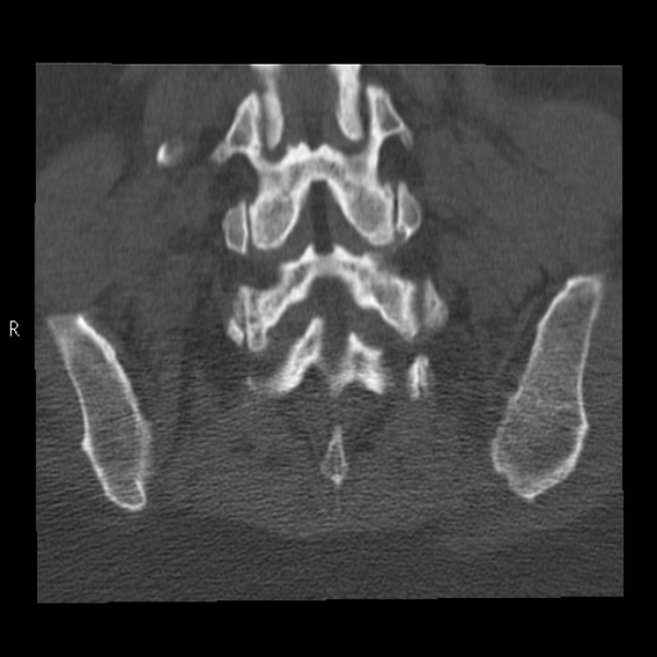 Bertolotti syndrome (Radiopaedia 24864-25128 Coronal bone window 39).jpg