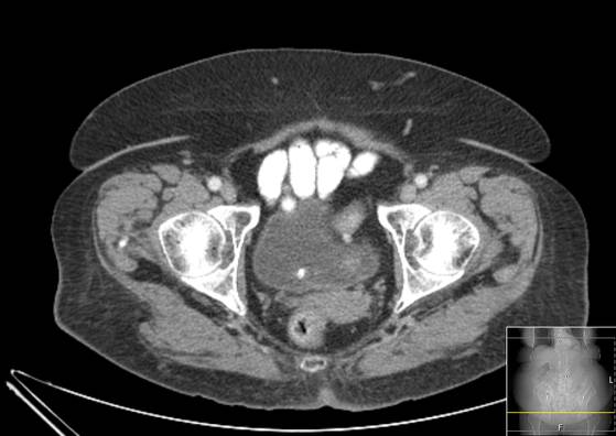 Bicameral celiacomesenteric aneurysm (Radiopaedia 55766-62327 A 68).jpg