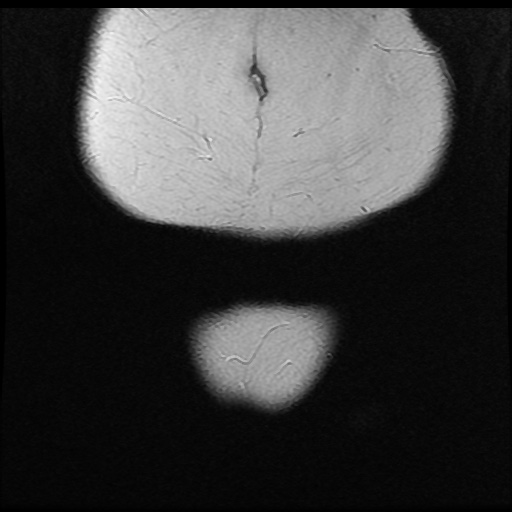 File:Bicornuate uterus (Radiopaedia 51676-57472 Coronal T2 1).jpg