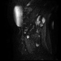 File:Bicornuate uterus (Radiopaedia 51676-57472 Sagittal DWI 31).jpg