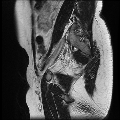File:Bicornuate uterus (Radiopaedia 51676-57472 Sagittal T2 21).jpg