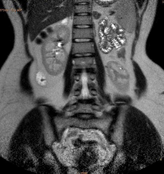 File:Bicornuate uterus with left renal agenesis (Radiopaedia 19829-19879 D 1).JPG