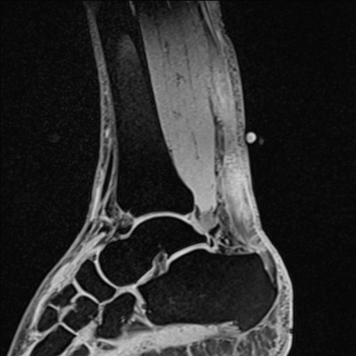 Bilateral Achilles tendon complete tear (Radiopaedia 81344-95051 Sagittal WE - Left 61).jpg