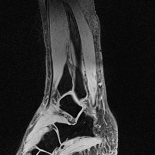 File:Bilateral Achilles tendon complete tear (Radiopaedia 81344-95051 Sagittal WE - Left 83).jpg