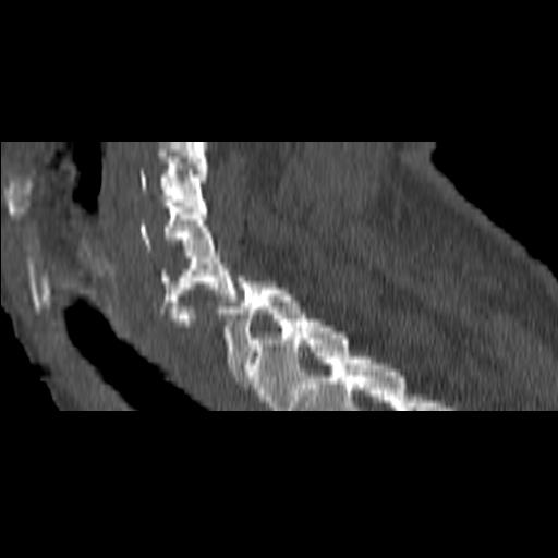 File:Bilateral C6-7 locked facet dislocation (Radiopaedia 28506-28748 Sagittal bone window 15).jpeg