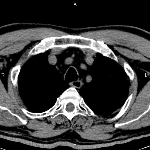 Bilateral Warthin tumors (Radiopaedia 84034-99263 Axial non-contrast 69).jpg