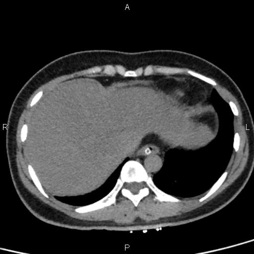 Bilateral adrenal gland hyperenhancement in pancreatitis (Radiopaedia 86642-102753 Axial non-contrast 11).jpg