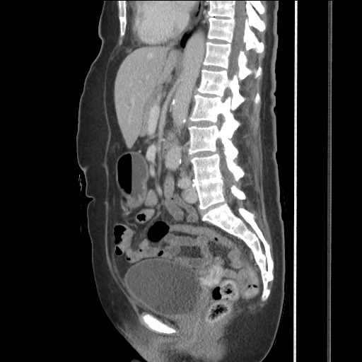 File:Bilateral adrenal granulocytic sarcomas (chloromas) (Radiopaedia 78375-91007 C 75).jpg