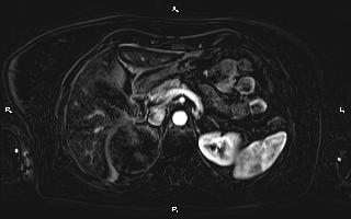 Bilateral adrenal myelolipoma (Radiopaedia 63058-71537 I 35).jpg