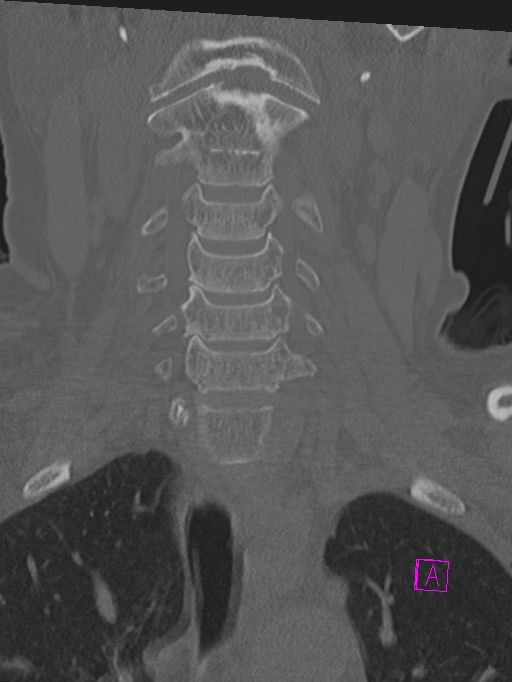 Bilateral atlanto-occipital assimilation (Radiopaedia 28350-28603 Coronal bone window 12).jpg
