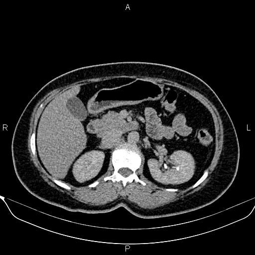 Bilateral benign adrenal adenomas (Radiopaedia 86912-103124 Axial C+ delayed 47).jpg