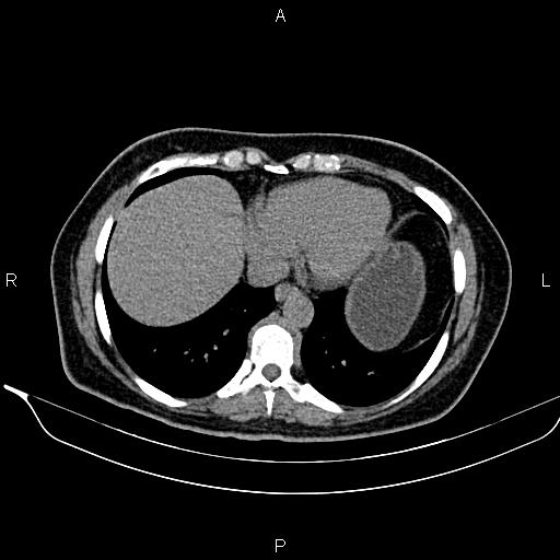 Bilateral benign adrenal adenomas (Radiopaedia 86912-103124 Axial non-contrast 15).jpg