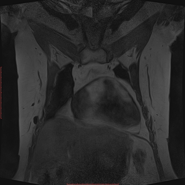 Bilateral breast implant rupture (Radiopaedia 24761-25027 G 17).jpg