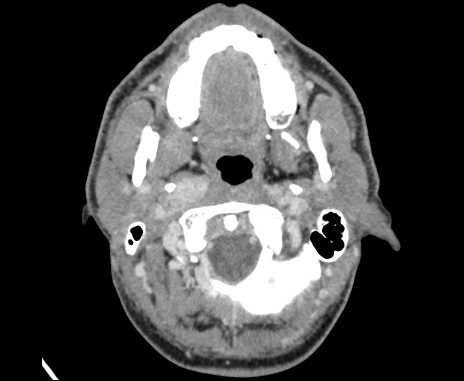 Bilateral carotid body tumors (Radiopaedia 61841-69870 Axial Post contrast 18).jpg