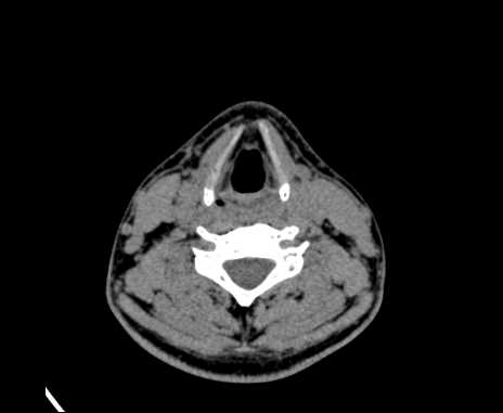Bilateral carotid body tumors (Radiopaedia 61841-69870 Axial non-contrast 67).jpg