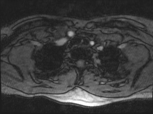 Bilateral carotid body tumors and right glomus jugulare tumor (Radiopaedia 20024-20060 Axial MRA 180).jpg