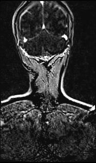 File:Bilateral carotid body tumors and right glomus jugulare tumor (Radiopaedia 20024-20060 MRA 141).jpg