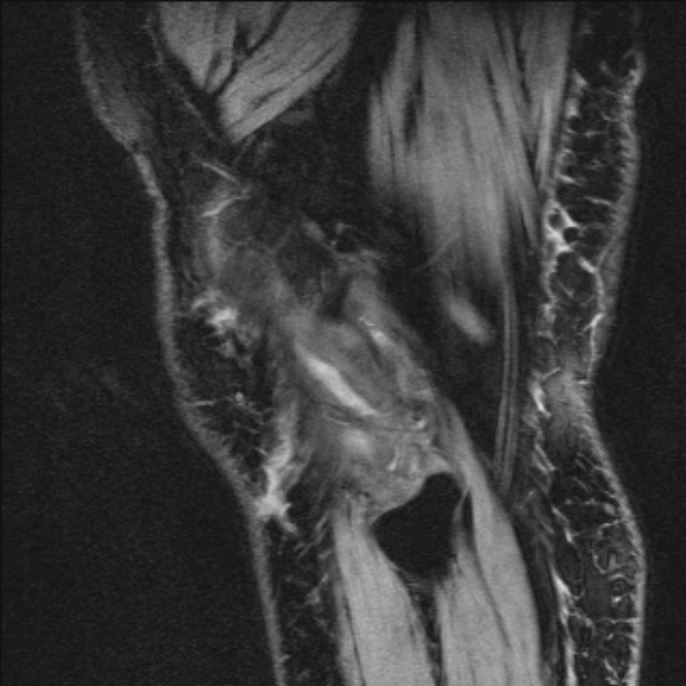 Bilateral focal pigmented villonodular synovitis (Radiopaedia 67643-77046 G 57).jpg