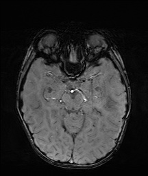 Bilateral mesial temporal polymicrogyria (Radiopaedia 76456-88181 Axial SWI 24).jpg