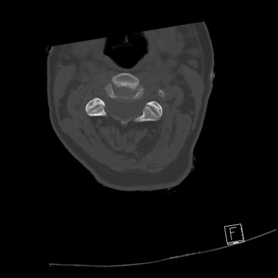 Bilateral occipital condyle fractures (type 3) (Radiopaedia 87672-104086 Axial bone window 29).jpg