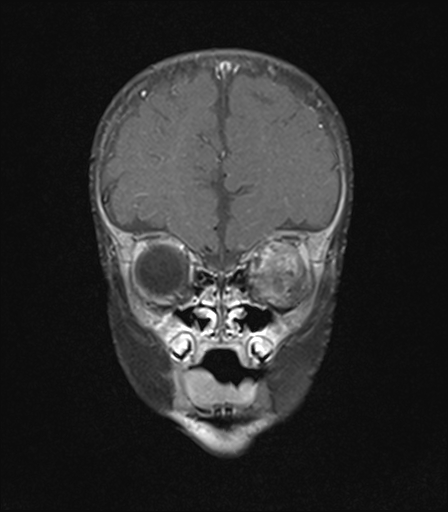 File:Bilateral optic pathway gliomas (Radiopaedia 40013-42514 D 1).jpg