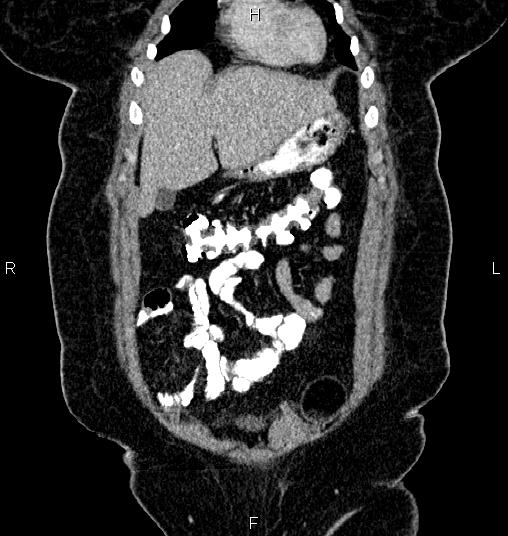 Bilateral ovarian dermoid cysts (Radiopaedia 85785-101603 C 6).jpg