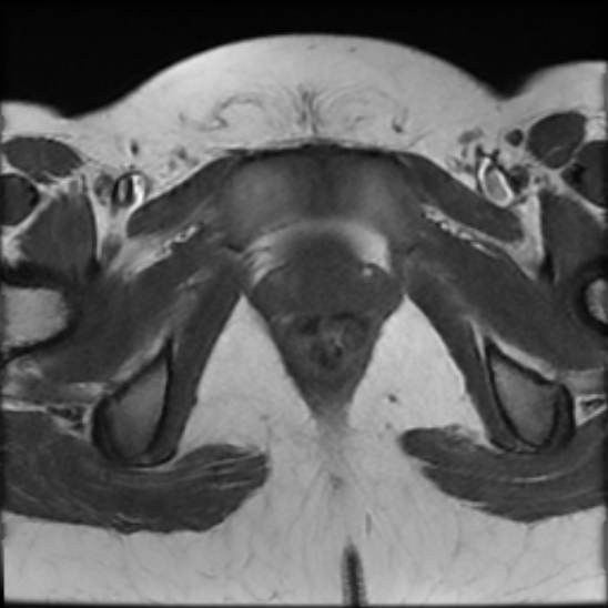 File:Bilateral ovarian fibrothecomas - adolescent (Radiopaedia 86604-102707 Axial T1 27).jpg