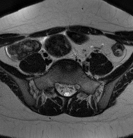File:Bilateral ovarian fibrothecomas - adolescent (Radiopaedia 86604-102707 Axial T2 6).jpg