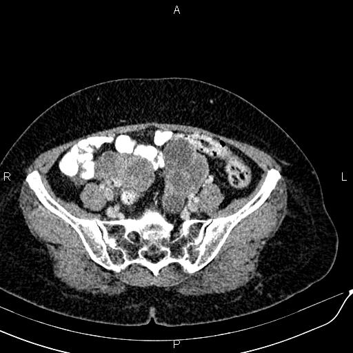 Bilateral ovarian serous cystadenocarcinoma (Radiopaedia 86062-101989 B 78).jpg