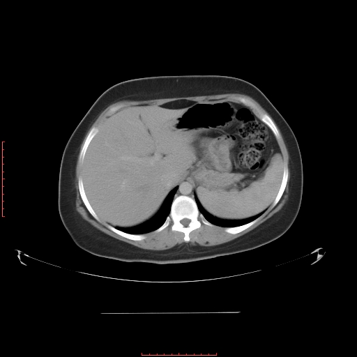 File:Bilateral ovarian serous cystadenocarcinoma with right ovarian torsion (Radiopaedia 32640-33611 A 9).jpg
