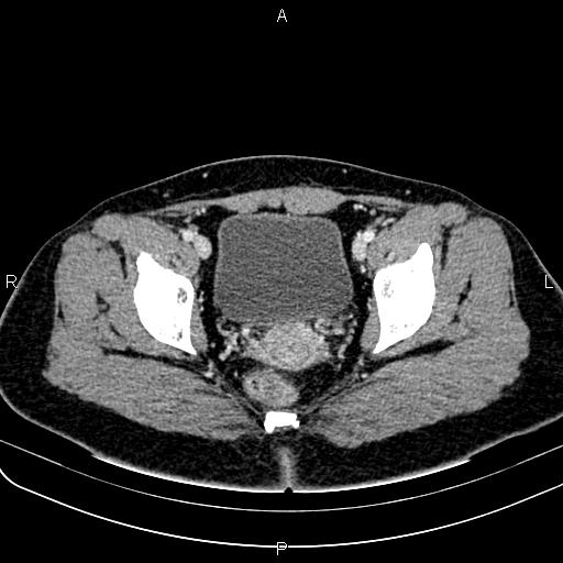 File:Bilateral ovarian teratoma (Radiopaedia 83131-97503 Axial With contrast 58).jpg