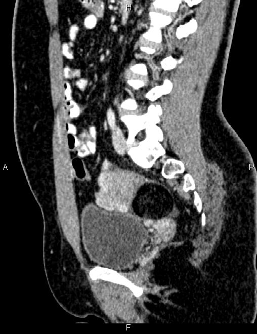 Bilateral ovarian teratoma (Radiopaedia 83131-97503 D 69).jpg
