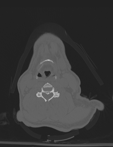 File:Bilateral perched facet joint (Radiopaedia 63149-71669 Axial bone window 33).jpg