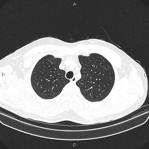File:Bilateral pulmonary AVM (Radiopaedia 83134-97505 Axial lung window 17).jpg