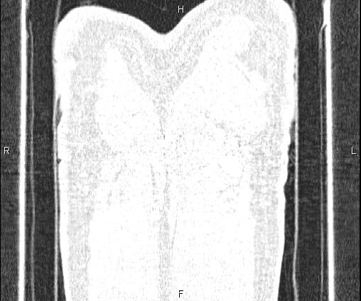 Bilateral pulmonary AVM (Radiopaedia 83134-97505 Coronal lung window 80).jpg