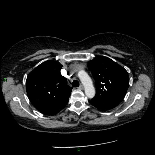 Bilateral pulmonary emboli (Radiopaedia 32700-33669 Axial C+ CTPA 33).jpg