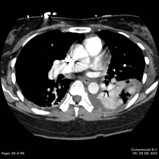 Bilateral pulmonary emboli with Hampton hump sign (Radiopaedia 54070-60246 Axial C+ CTPA 35).jpg