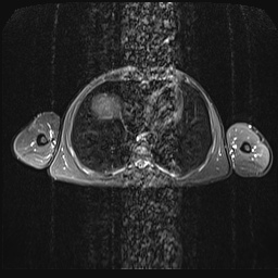 File:Bilateral spinoglenoid notch ganglion cysts (Radiopaedia 29577-30082 E 25).jpg