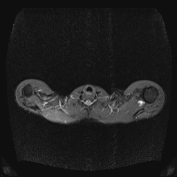 File:Bilateral spinoglenoid notch ganglion cysts (Radiopaedia 29577-30082 E 4).jpg