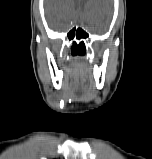 Bilateral submandibular sialolithiasis with sialadenitis (Radiopaedia 70721-80881 Coronal non-contrast 14).jpg