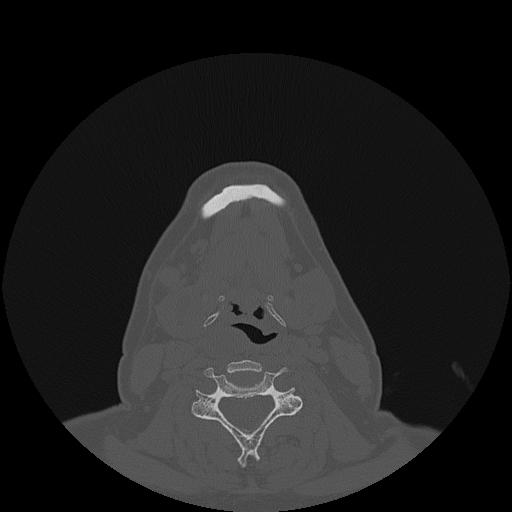 File:Bisphosphonate-related osteonecrosis of the jaw (Radiopaedia 71324-81642 Axial bone window 13).jpg